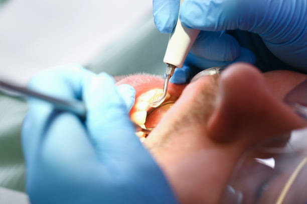 Best Emergency Gum Treatment in Aurora, SD