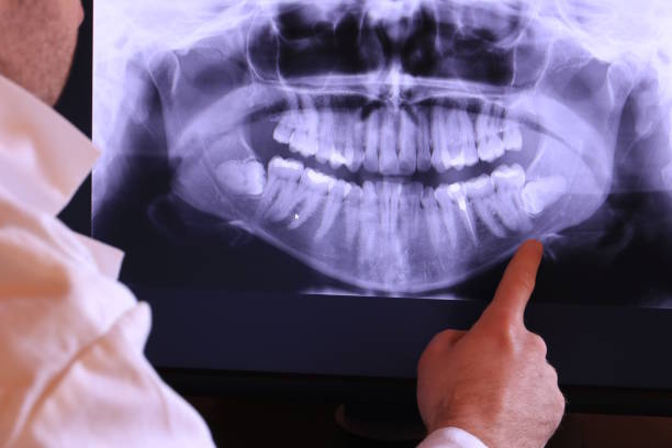 Best Emergency Wisdom Teeth Removal in Aurora, SD