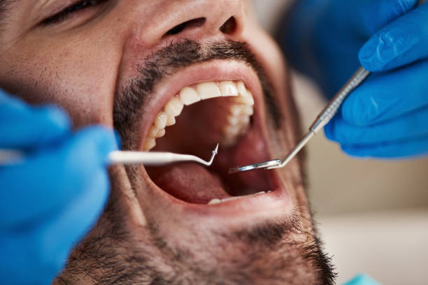 Best Emergency Dental Care for Broken or Chipped Teeth in Aurora, SD
